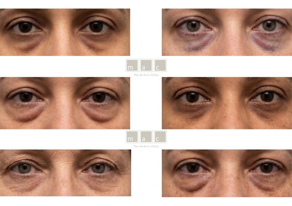 Different types of dark circles under the eyes, including pigmentation, vascular and structural
dark circles