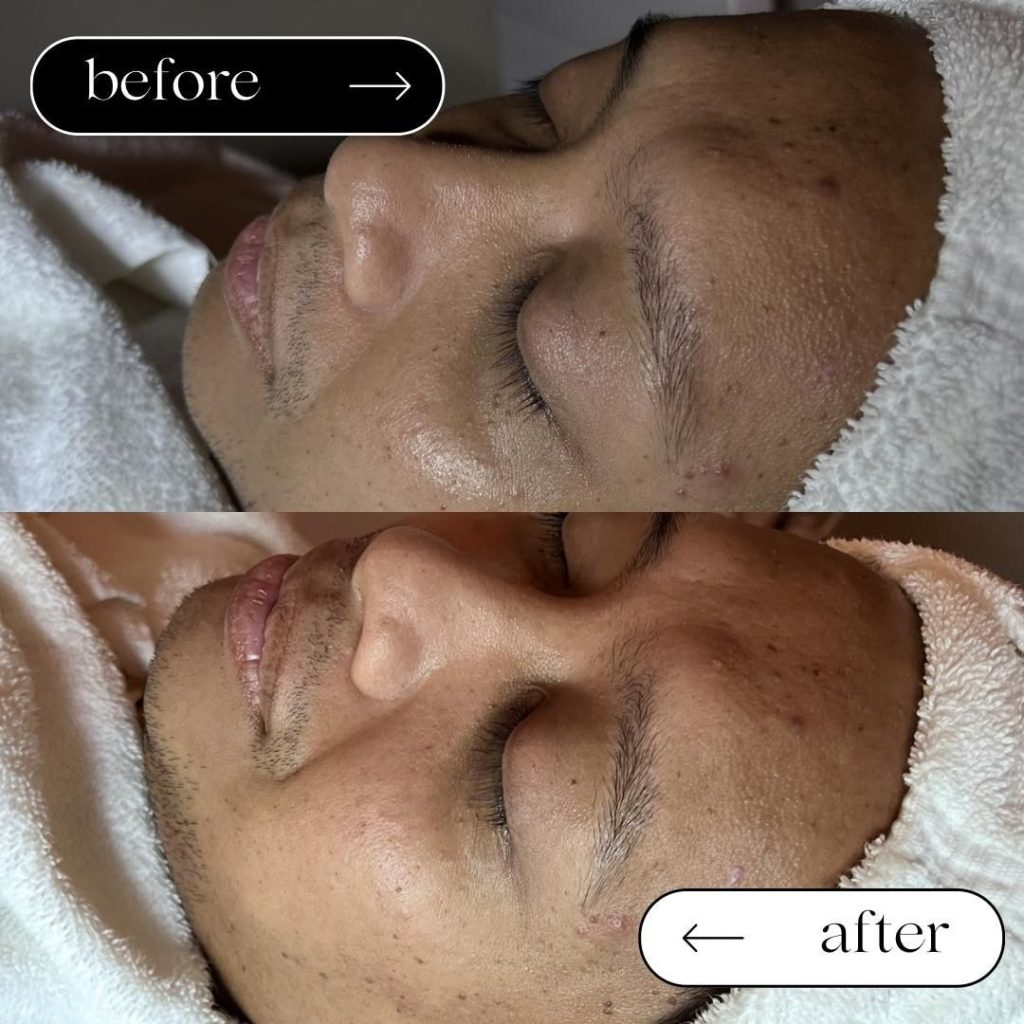 Before_After_GLACE_skin_treatment_Mac_clinic_Ampang